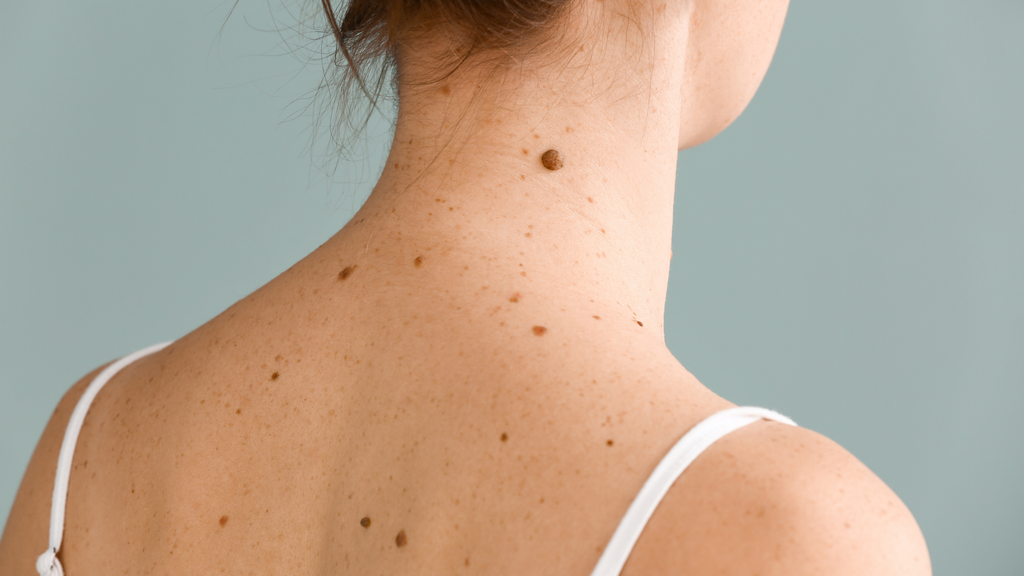 Why do I get moles on my skin? Skin Health Blog Solbari Solbari