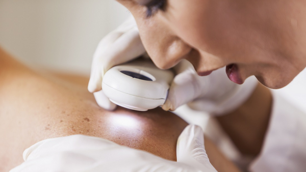 Why is skin cancer more likely after an organ transplant?