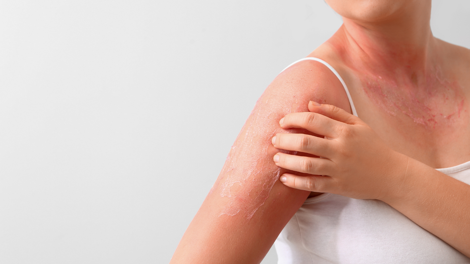 Why does skin peel after sunburn?